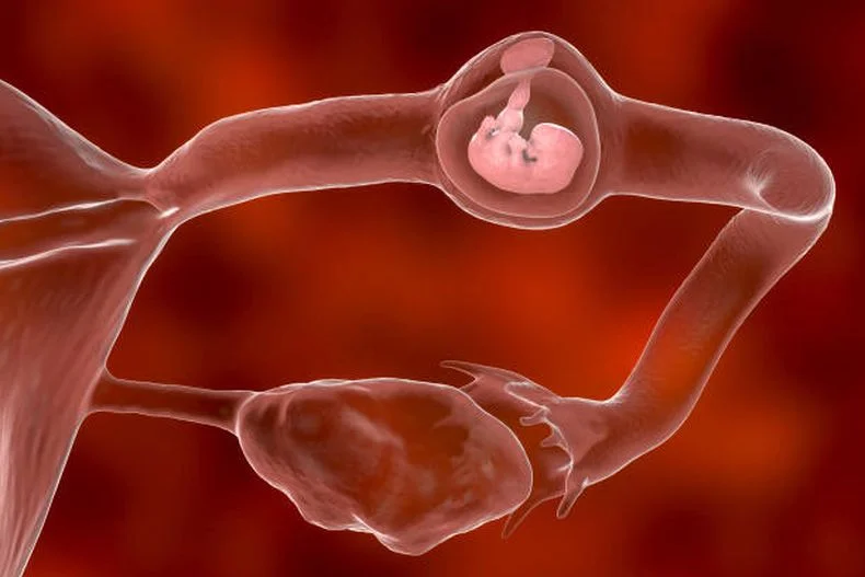 Imagen ilustrativa de un embarazo ect&oacute;pico.