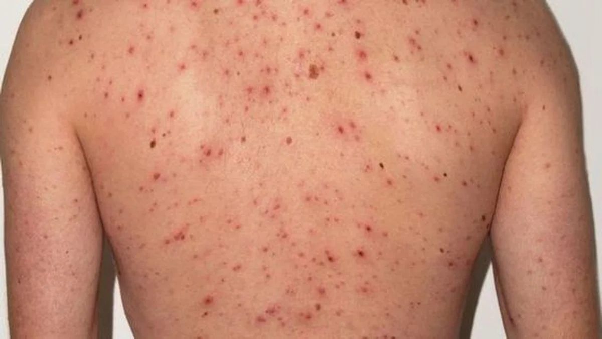 Alerta epidemiológica en Chile por aumento de casos de sarampión en Argentina