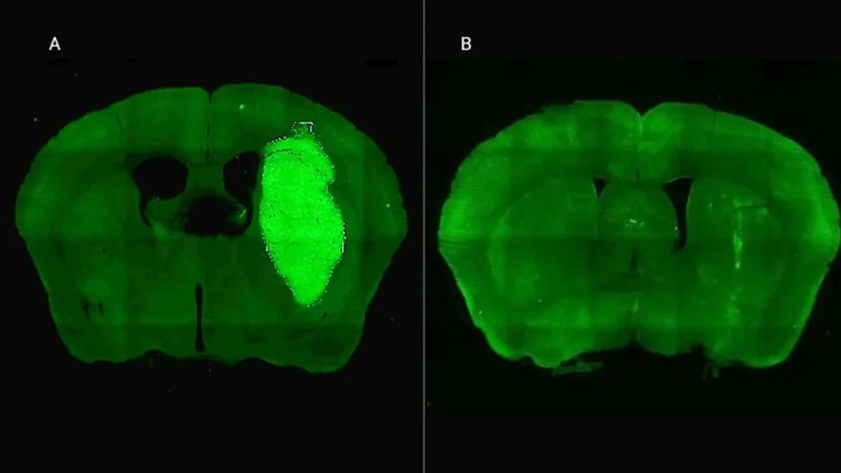 Especialistas del Conicet lograron frenar un tipo de cáncer cerebral con una novedosa estrategia terapéutica